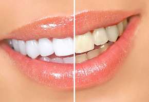 Эффективное домашнее средство от желтизны зубов